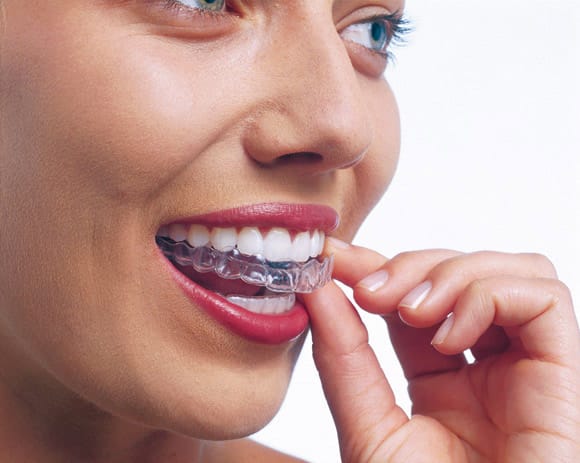 chica-quitandose-invisalign